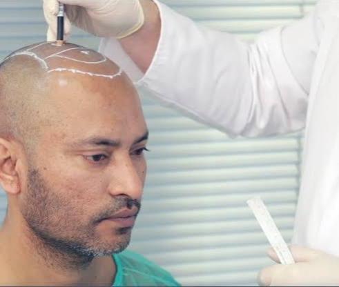 Hair Transplantation Clinics